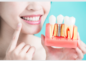 Yes-Dentistry dental implants Adelaide